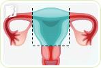 Hot Flashes after a Hysterectomy