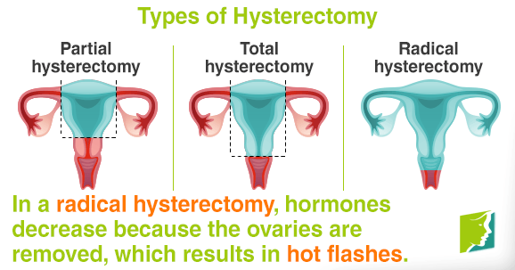 In a radical hysterectomy, hormones decrease because the ovaries are removed.