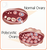 irregular-periods-polycystic