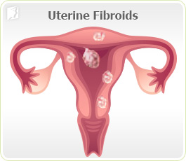 Irregular Period Treatments5
