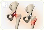 Is Osteoporosis Painful?
