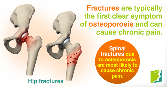 Fractures are the first clear symptom of osteoporosis and can cause chronic pain