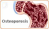 Is There a Higher Risk of Osteoporosis during Perimenopause?