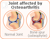 joint-pain-menopause