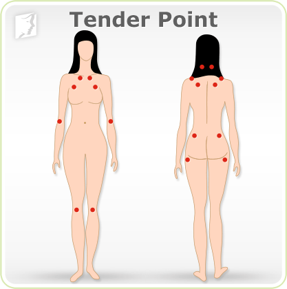 Tender point