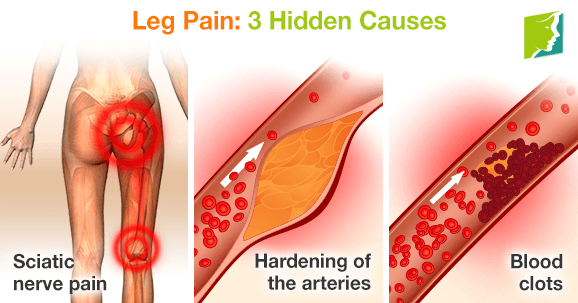 Leg Pain: 3 Hidden Causes