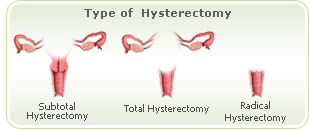 Types of radical hysterectomy
