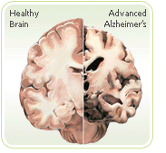 menopause Alzheimers