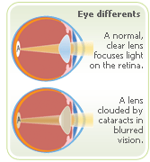menopause symptoms cataract