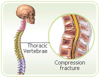 osteoporosis vertebrae