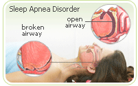 news sleep disorders