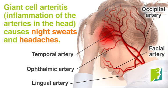 Inflammation of arteries in the head causes night sweats and headaches