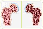 Osteopenia and Osteoporosis: The Difference