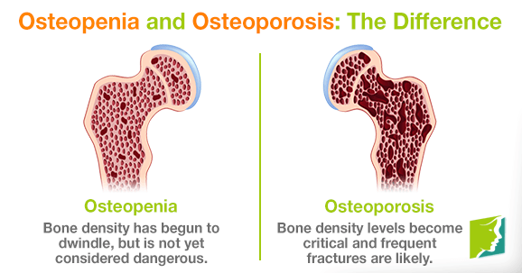 Osteopenia and Osteoporosis: The Difference