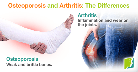 Osteoporosis and Arthritis: The Differences