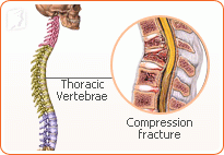 Stronger Treatments for Osteoporosis 2