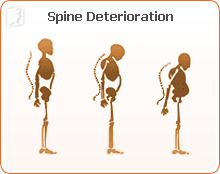 Spine Deterioration