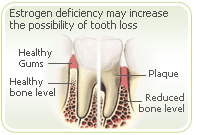Osteoporosis tooth
