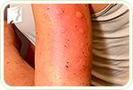 Skin Allergies and Rashes during Menopause