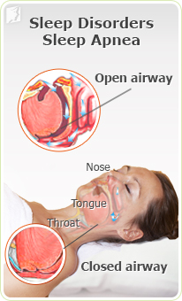 Sleep disorders and sleep apnea