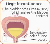 Triggers for Urinary Incontinence 2