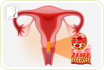 Vaginal Bleeding during Postmenopause