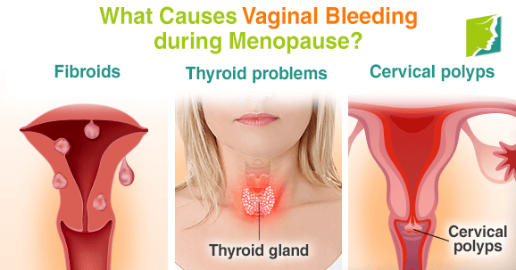 What are the symptoms of thrush, what causes oral and vaginal yeast infections, how is it treated and can men get it